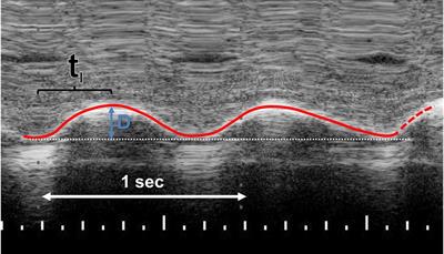 Diaphragmatic ultrasound and patent ductus arteriosus in the newborn: A <mark class="highlighted">retrospective case series</mark>